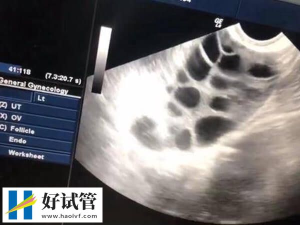 试管婴儿第一次检查要查什么？女性心电图、乙肝5项不可少