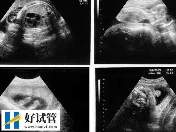 安顺试管婴儿移植第38天孕囊应该多大