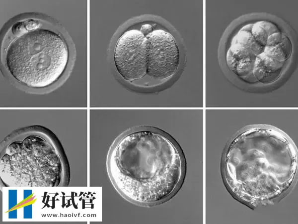 黔东南试管婴儿的胚胎等级如何划分