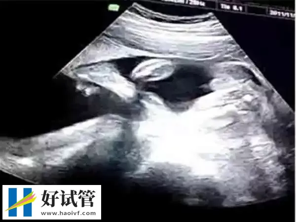 巴中试管婴儿移植35天孕囊偏小怎么办