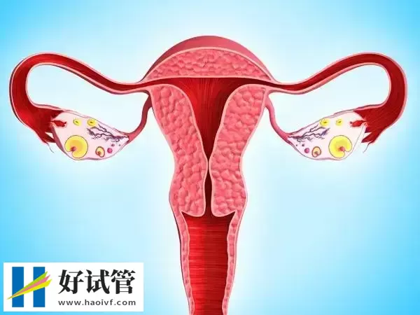 凉山子宫内膜异位症试管婴儿适合什么方案