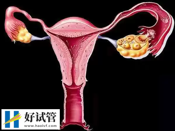 凉山输卵管不孕试管婴儿成功率多少