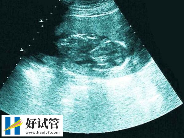 试管婴儿胎停概率公布,若有这些症状就得提高警惕!(图1) 试管婴儿胎停概率是多少