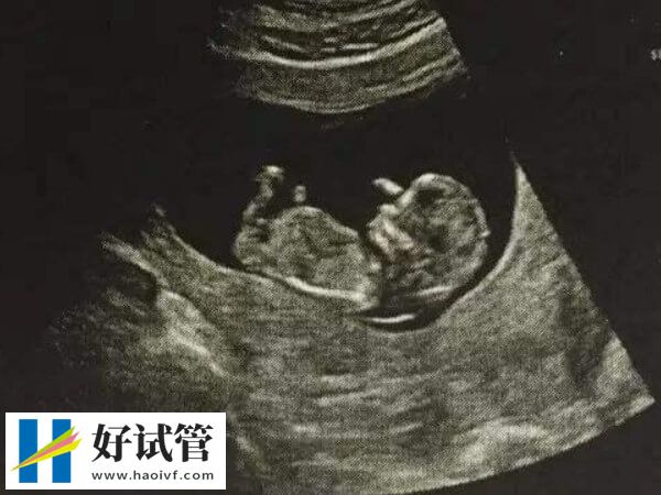 试管婴儿胎停概率公布,若有这些症状就得提高警惕!(图2) 试管婴儿胎停几率与什么因素有关