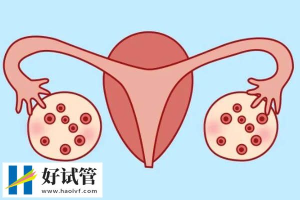 卵巢取卵是从单侧取还是双侧(图1) 能双侧取卵尽量别单侧