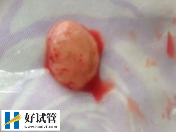 胚胎移植后可以提多少斤的东西(图3) 孕期搬动25千克以上重物不安全