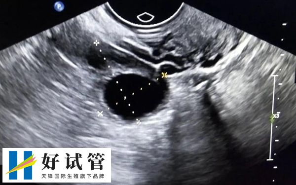 卵泡位置高好不好取卵(图1) 卵泡位置高低影响取卵成功率