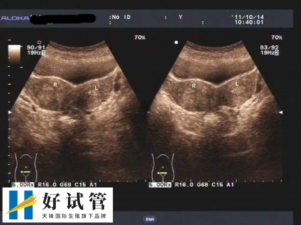 荆州中心医院试管双胞胎费用