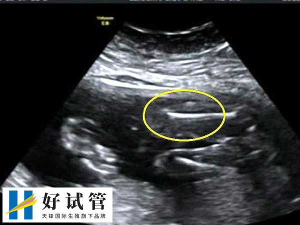 胚胎移植后要查几次B超转科室(图1) 3次B超确认胎儿发育正常即可转产科