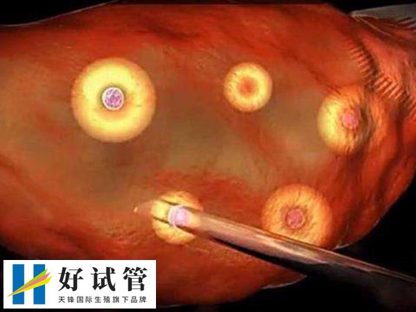 进周促排卵后取多少卵泡比较合适(图1) 取卵数量一般在8到15个之间