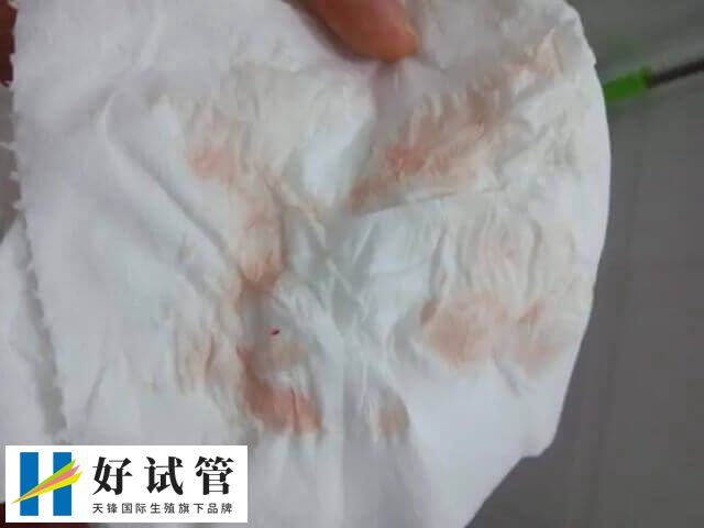 试管移植后翻倍正常却出血咋回事(图1) 试管移植后少量出血是着床了