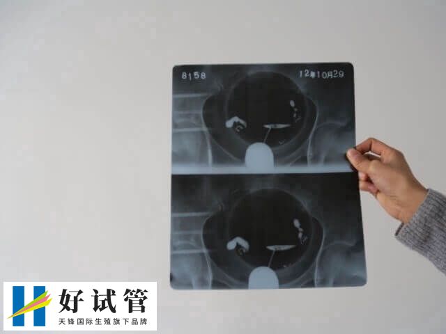 试管移植20天药渣有血什么原因(图2) 宫颈疾病可能导致出血