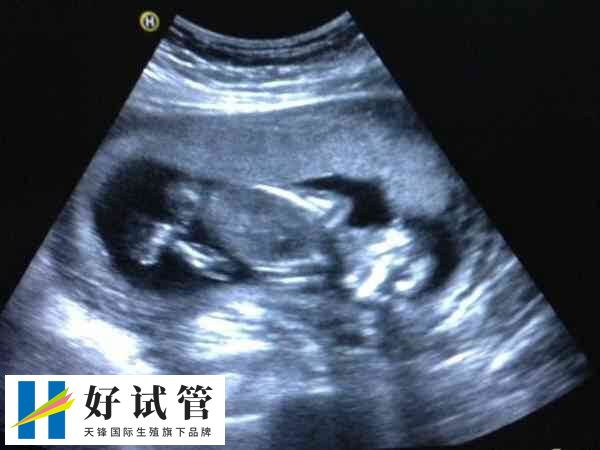做试管宫腔镜后多久移植最佳
