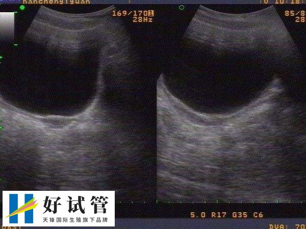 纵隔子宫能不能做试管婴儿