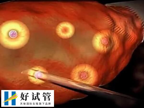 取了21个卵子为何才成了1个胚胎(图1) 试管取21个左右的卵子是比较理想的