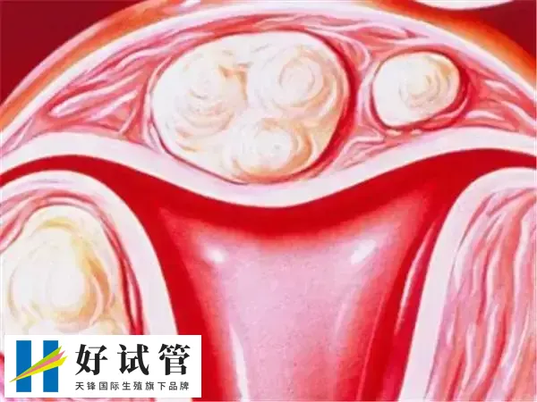 宫颈息肉试管老是生化怎么办(图1) 子宫具有天然的铲除异物的才能