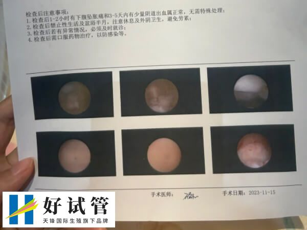 降调卵泡不均匀是怎么回事(图2) 试管婴儿是现代医学技术的奇迹