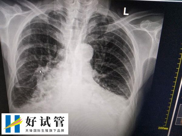 试管移植后肩胛骨疼怎么回事