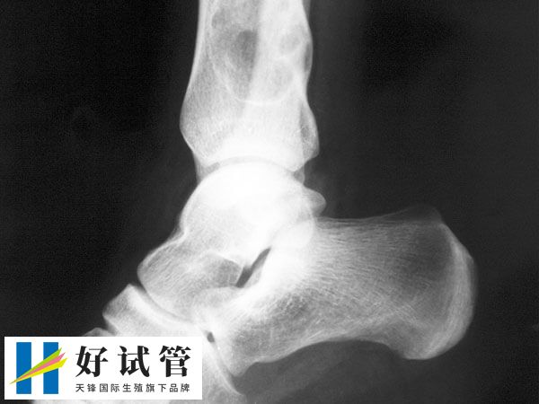 试管婴儿后发现骨肉瘤怎么办