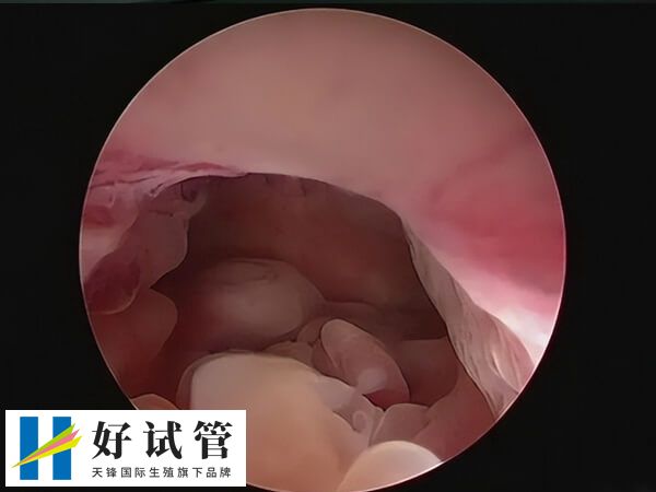 如何诊断子宫内膜息肉(图1) 子宫内膜息肉需要检查确诊