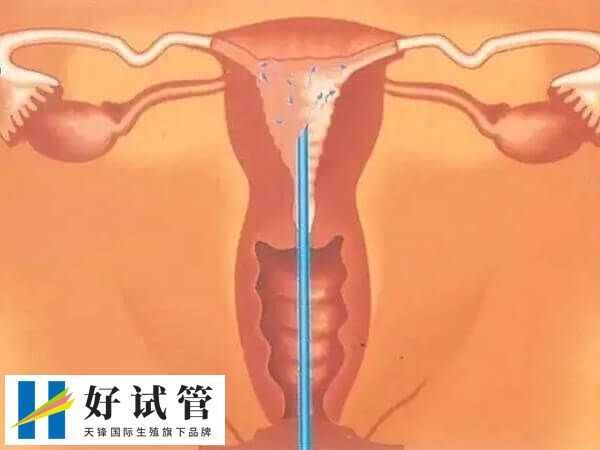 石家庄做人工授精费用多少